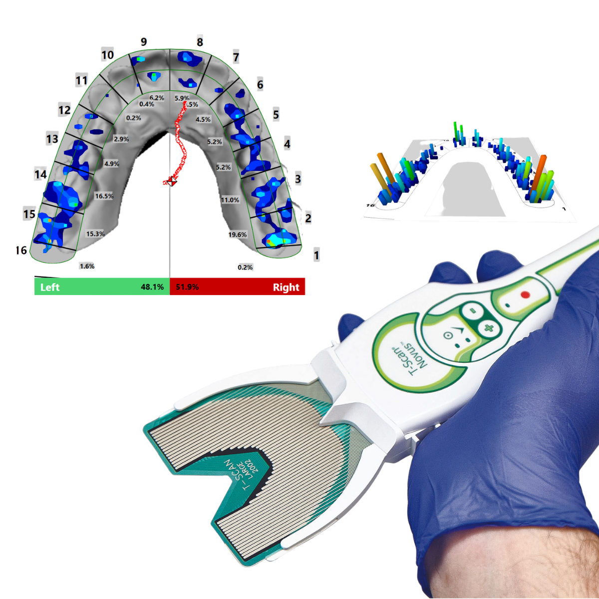 Tekscan T-Scan Novus et Bioresearch BioEMG mesure de l'occlusion dentaire en dynamique, force et chronologie des contacts dentaires, relaxation, synergie et synchronisation musculaire